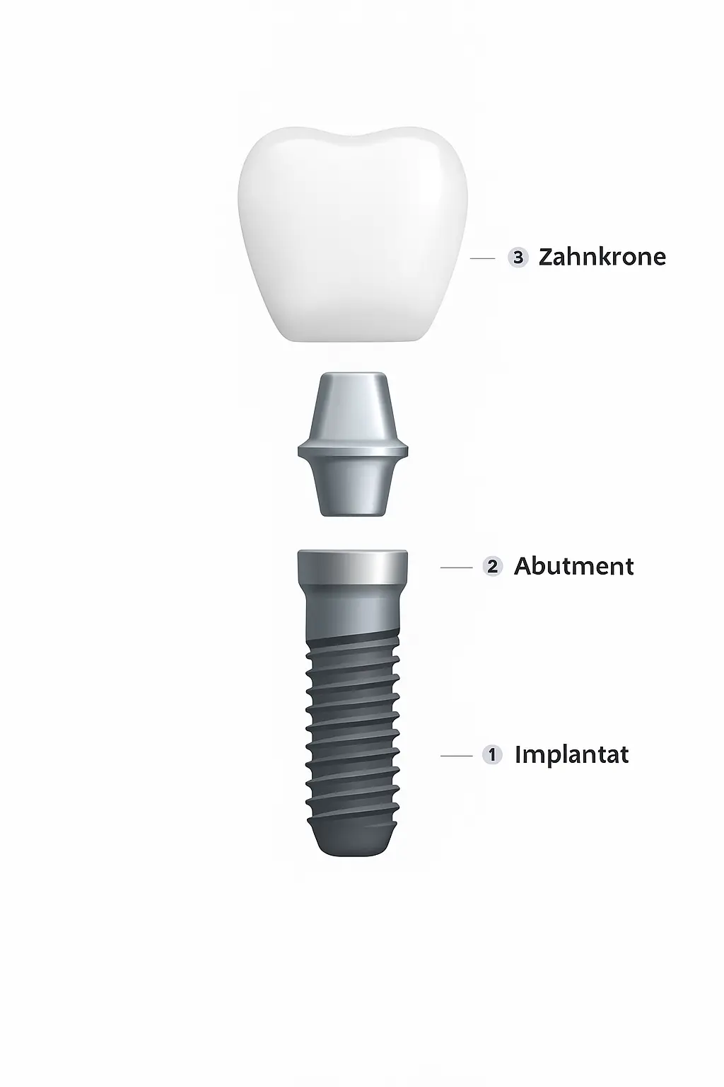 Aufbau eines Zahnimplantats mit Implantat, Abutment und Zahnkrone